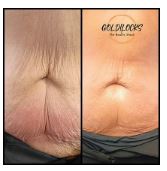 Cavitation body contouring results