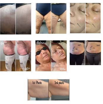 Selection of advanced treatment results