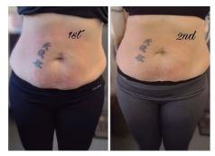 Cavitation body-contouring before and after