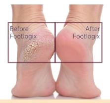 Feet — before and after a Footlogix pedicure course